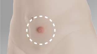 Abdomen shown of someone that has a body profile with a flat area around the stoma